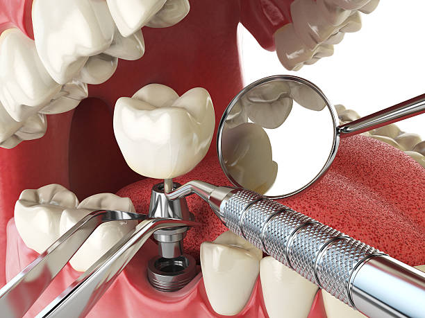 Best Emergency Treatment for Dental Infections or Abscesses in Silver Lake, FL